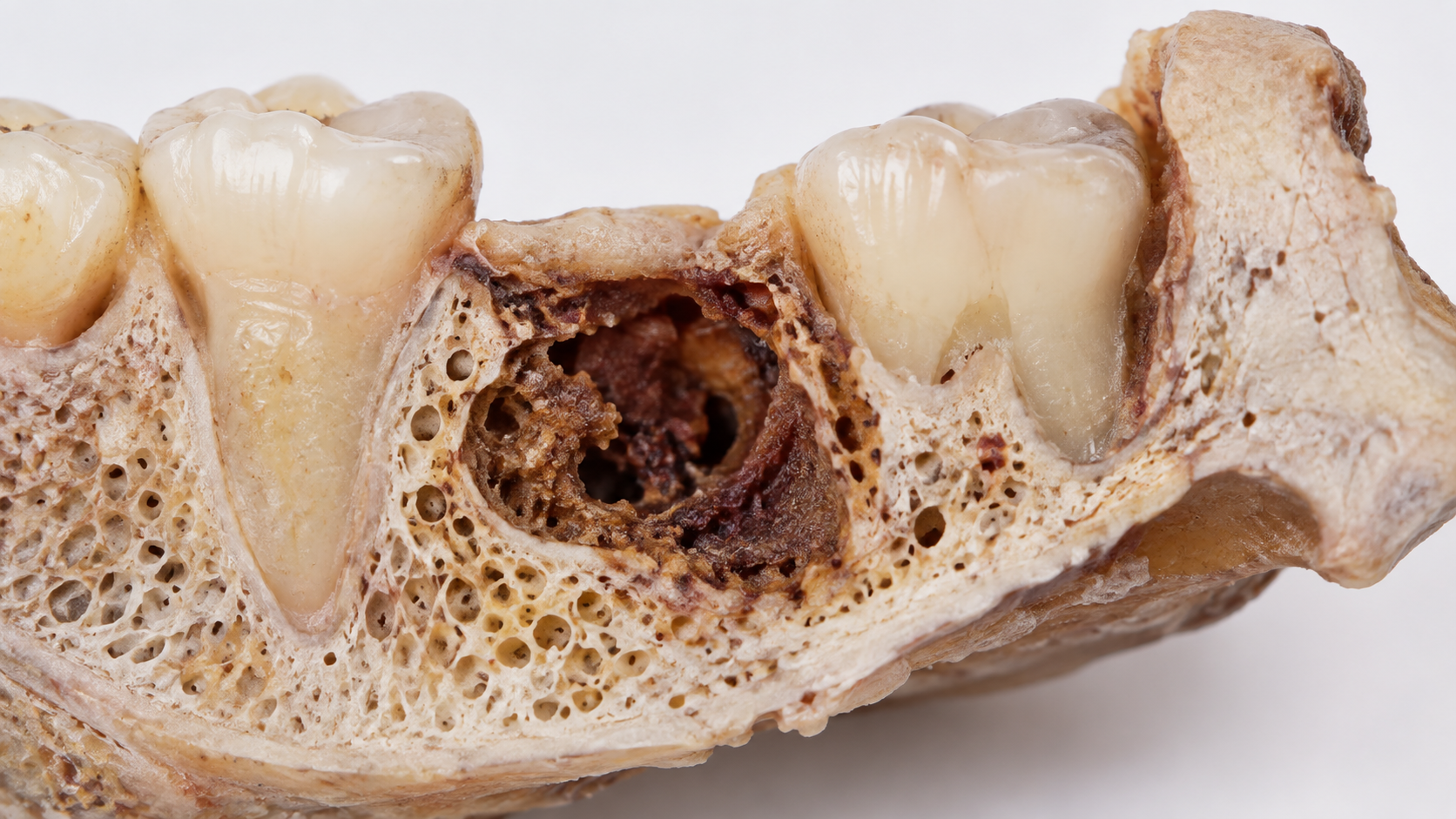 Cavitación ósea mandibular